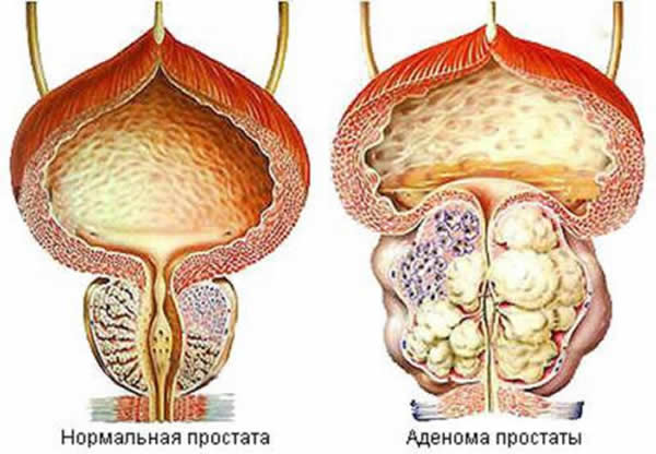 Лечение аденомы простаты